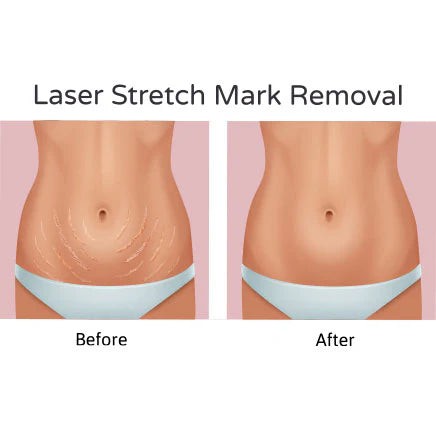 Stretch Mark Treatment (Tummy)