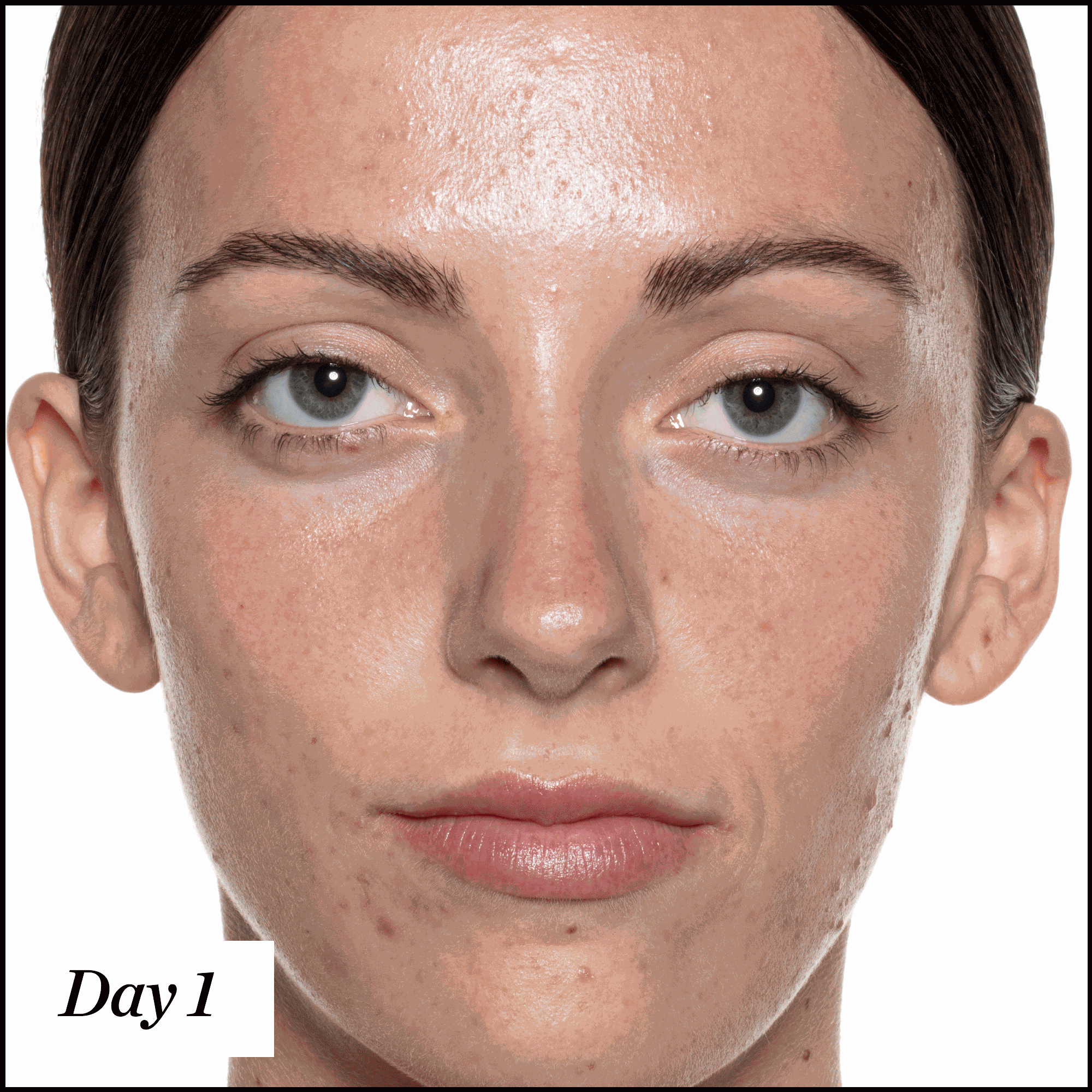 U.F.O. Acne Treatment Face Oil