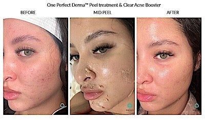Facial- Chemical Derma Peel