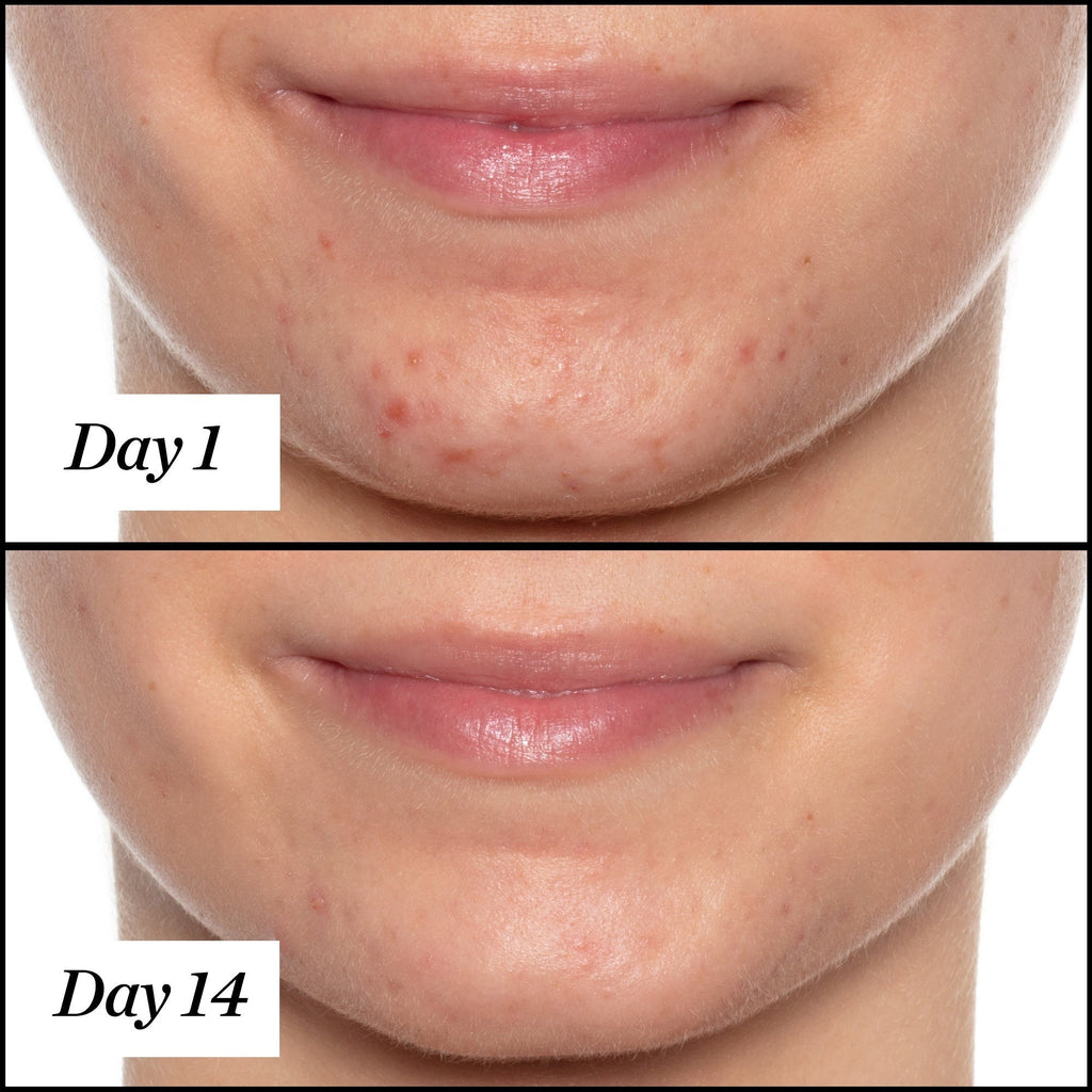 U.F.O. Acne Treatment Face Oil